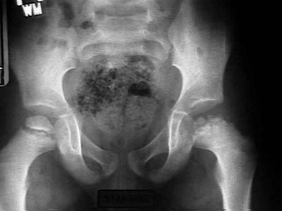 Legg-Calve-Perthes_Disease (4).jpg